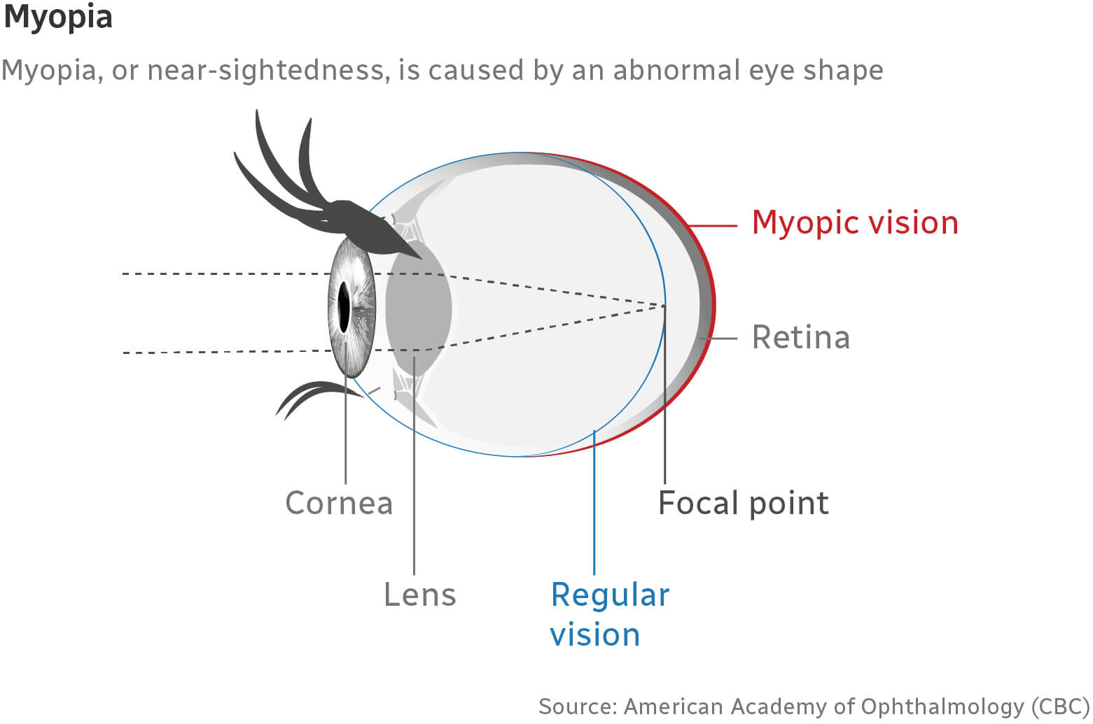 Diagram on an eye when affected by Myopia.